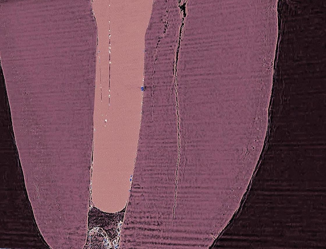 Das Bild zeigt Details an der Grenze zwischen Füllung und Zahnwurzel - vergrößerte Ansicht